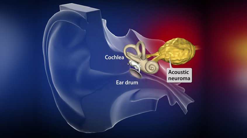 brain-acoustic-schwannoma-treatment-in-lucknow
