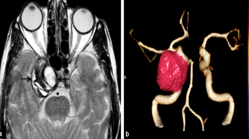 brain-cavernous-sinus-tumor-treatment-in-lucknow