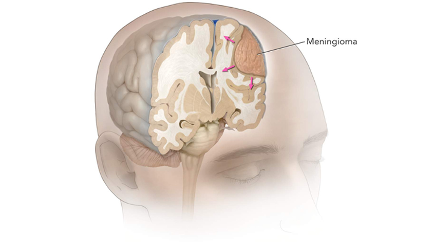 brain-meningioma-treatment-in-lucknow