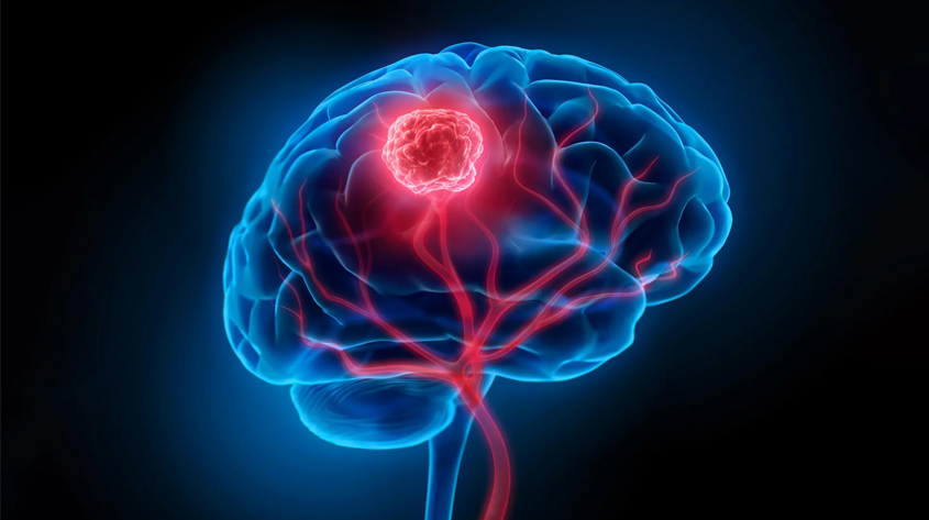 brain-tumor-specialist-in-lucknow