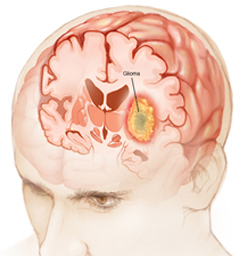 Glioma Surgery