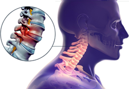 Cervical Myelopathy