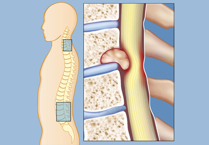 Spinal Cord Tumor