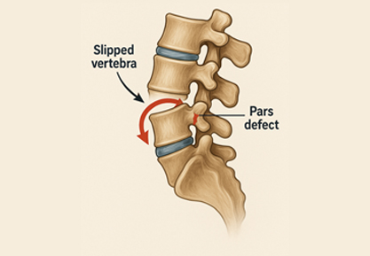 Spondylolisthesis