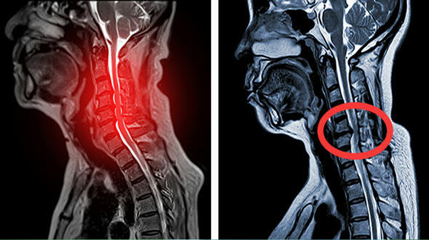 Cervical Myelopathy