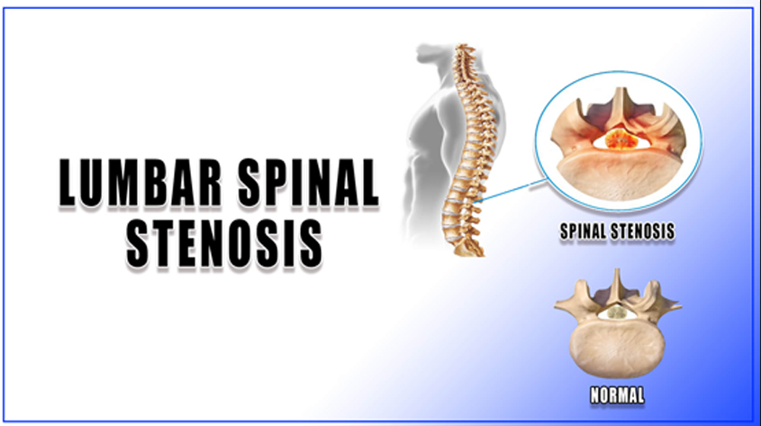 Lumbar Canal Stenosis