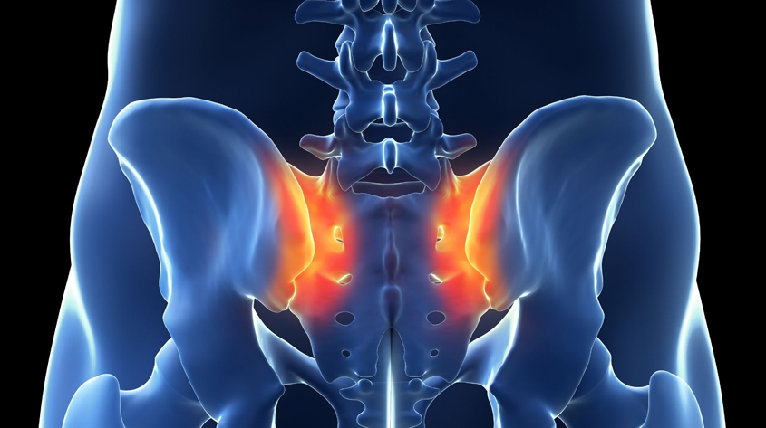 Sacral Tumor