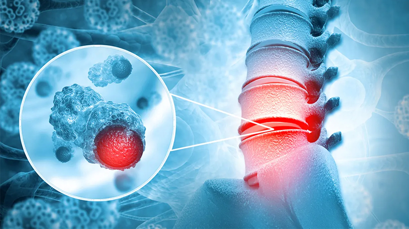Spinal Cord Tumor