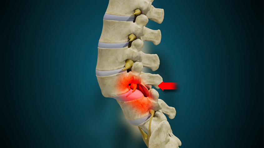 Spondylolisthesis